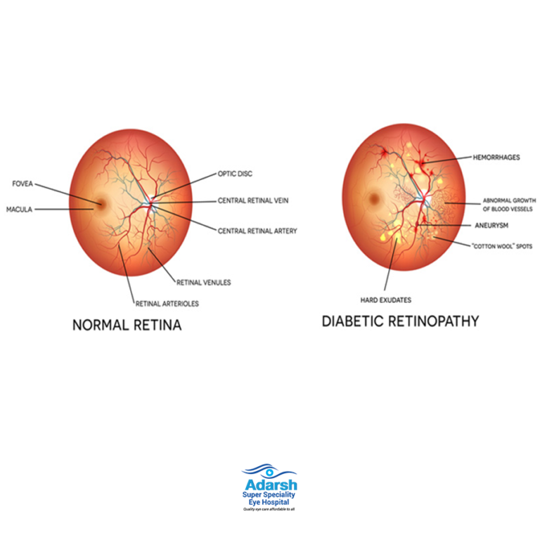 CATARACT SERVICES